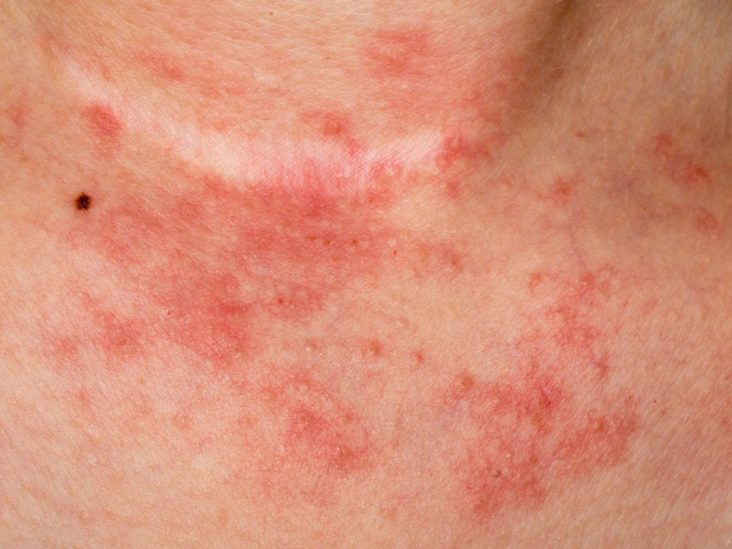Dermatitis y comezón en la piel: ¿Es el jabón de azufre culpable?