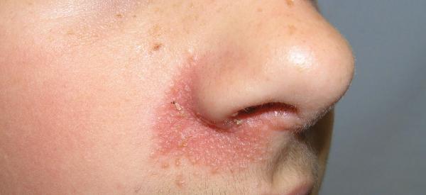 El jabón de azufre: ¿Por qué deja mi rostro rojo y cómo solucionarlo?